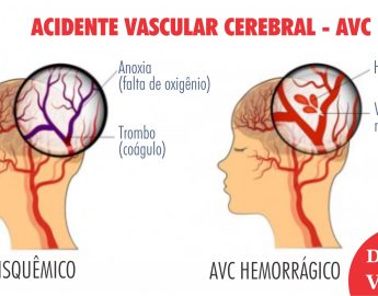 Coluna: Novembro Azul – AVC