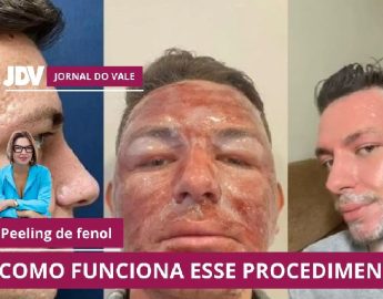 Vídeo – Compreenda os cuidados para realização do Peeling de Fenol