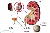 Dica do Dr. Vicente – Cálculo Renal