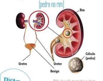 Dica do Dr. Vicente – CÁLCULO RENAL